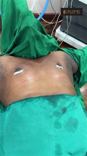 Gynecomastia Surgery