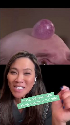 Dr Pimple Popper Explains Forehead Growth!