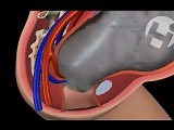 Cord Prolapse • Video • MEDtube.net