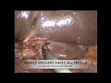 Laparoscopic Pancreatico-Duodenectomy • Video • MEDtube.net