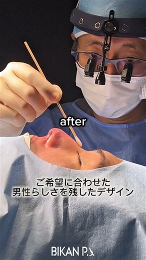 拘縮鼻の当日施術レポ👓#BIKAN整形外科 #BIKAN CLINIC #鼻翼縮小 #鼻整形 #鼻中隔延長 #団子鼻 #渡韓整形 #鼻尖形成 #整形レポ #鼻整形ダウンタイム #鼻フル #小鼻縮小