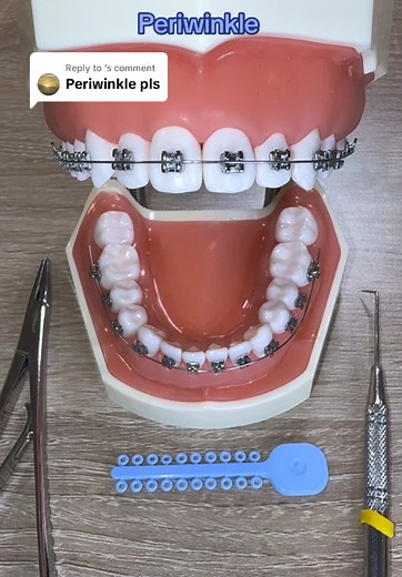 Discover Periwinkle Braces and Color Options