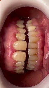 Tratamento periodontal cirúrgico com redução de bolsas e aplicação de Emdogain imediato