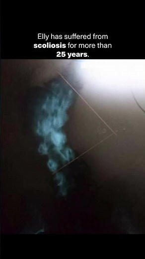 80-Degree Scoliosis: Why I Chose Functional Patterns Over Surgery