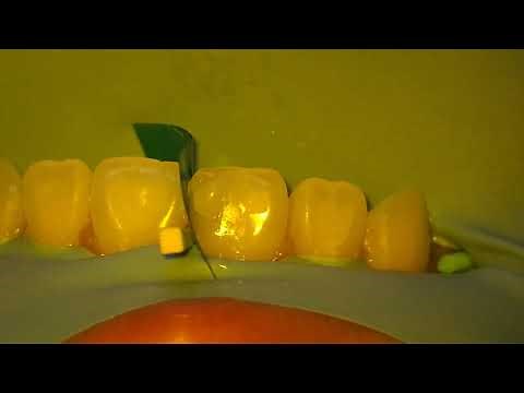 Repairing a Cavity in a Front Tooth