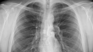 clip-5778215-chest-x-ray-animation-breathing-beating-heart