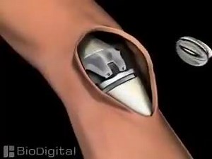 95K views · 932 reactions | Medical Animation of a Knee Replacement | Animation Boss | Facebook