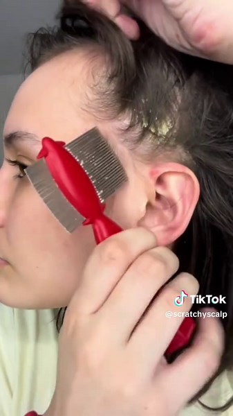 Psoriasis Removals: Satisfying Scalp Treatments