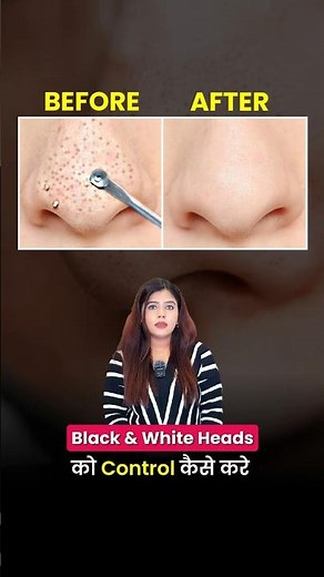 how to remove whiteheads from nose