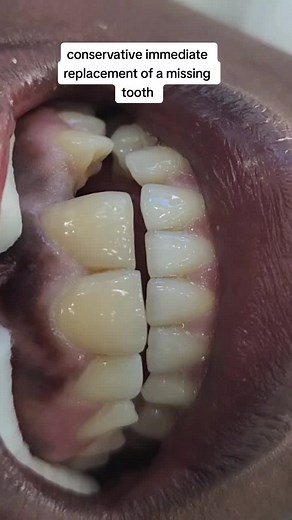 Innovative Fibre Bridges for Affordable Tooth Replacement