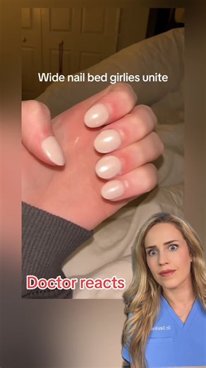 Dr. Dana Figura, DPM on Instagram: "Explaining what clubbed fingers are and how to test for them! (VC: itnotabigail7 on tt) #clubbednails #doctor #doctorreacts #medical"