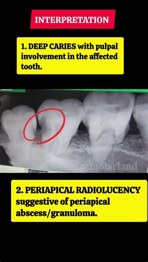 rvg interpretation 2 #endodontics #radiovisiograph #dentistry #dentist #interpretation