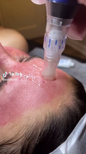 SkinPen® Precision Skin Treatment for Tightening, Brightening, and Lifting