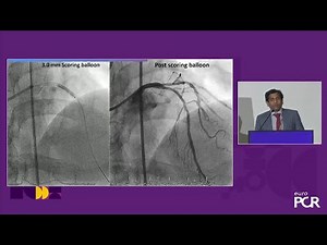 Sirolimus-coated balloon: expanding scope of indications for complex CAD treatment - EuroPCR 2024