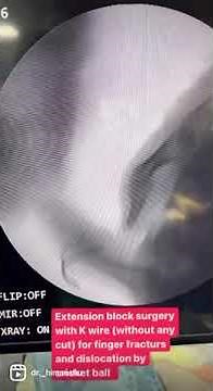 Finger fracture dislocation surgery
