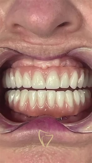 Protocolo carga imediata bimaxilar (instalação das próteses nas arcadas superior e inferior 72 horas após a cirurgia de instalação dos implantes). Esse tratamento é muito seguro, eficaz e muito durável! #dentista #dentistanotiktok