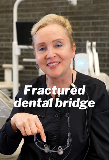 Fractured Crowns and Bridges: What You Need to Know