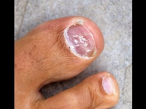 Toenail Fungus Treatment - Home Remedies For Toenail Fungus Know to Work Quickly