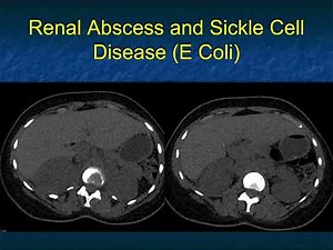 The Differential Diagnosis of Loss of Renal Corticomedullary Interface - Part 2