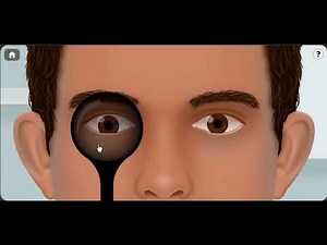 cover uncover test in patients with vertical squint