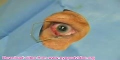 Intravitreal Injection Technique Video