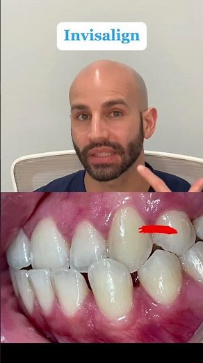Invisalign To Fix A Front Crossbite