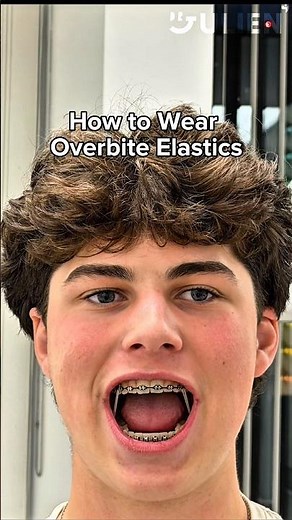This is How You Wear Class 2 Overbite Elastics #braces