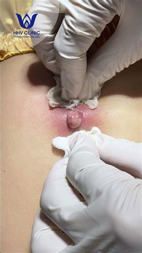 Nặn mụn nhọt ở lưng.