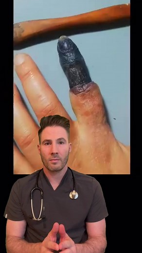 Horror Makeup: Understanding Finger Gangrene