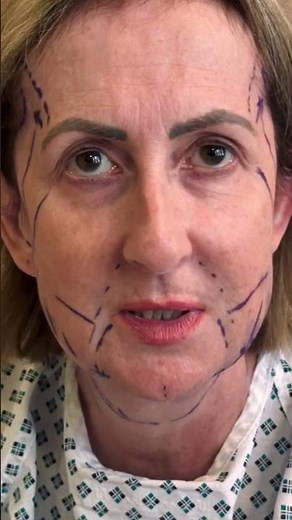 Deep Plane Facelift Before & After