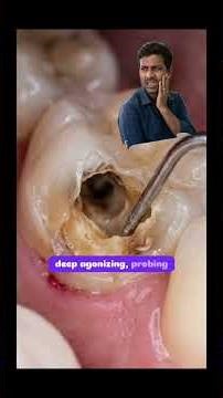 “What Happens When Tooth Decay Progresses? #oralhealth #dentist #drajay #bestdentalcare