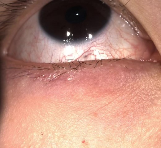 IPL Dry Eye Treatment with meibomian gland expression for a patient with rosacea
