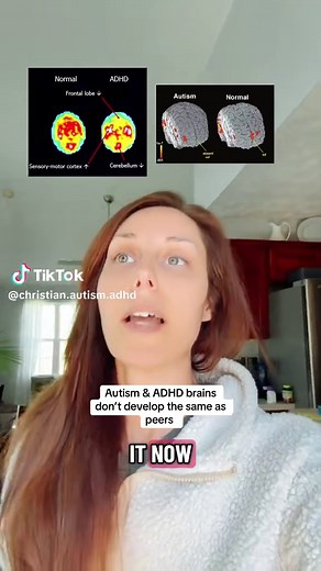 Understanding the Prefrontal Cortex in ADHD and Autism