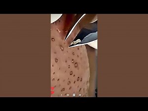 Skincare | Blackheads Removal #687 #tweezers skincare #blackheads blackheads