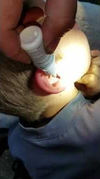 Removal of the spider in Thomas' ear!