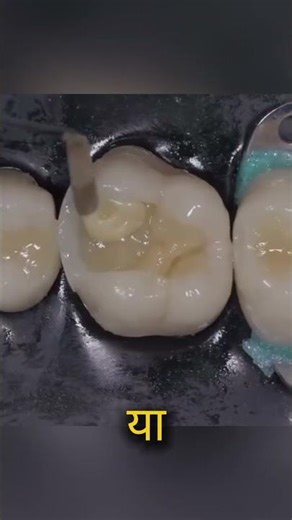Fixing Cavities Between Teeth #shorts #cavities #teeth