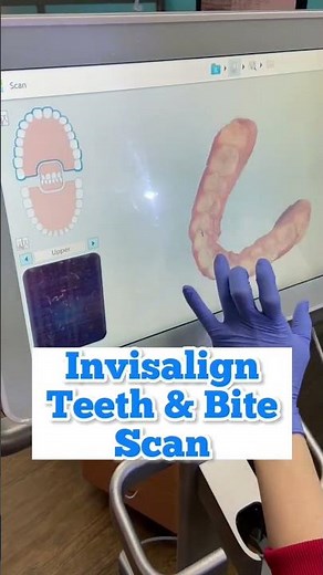 Invisalign iTero Digital Scan: How we take accurate “impressions” of your teeth and bite.