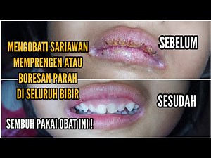 Mengobati sariawan, memprengen atau boresan parah di seluruh bibir - Pakai salep ini!