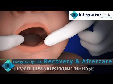 Tongue/Lip Tie - Recovery & Aftercare