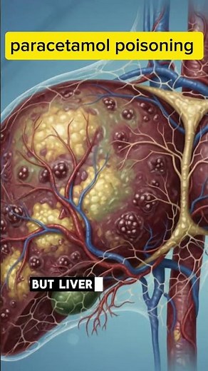 Paracetamol Poisoning: Symptoms, Danger Signs & Emergency Treatment Explained!