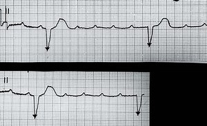 Bloqueo auriculoventricular
