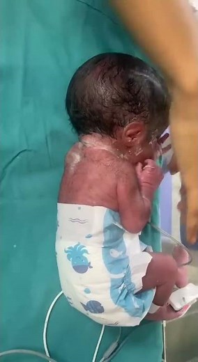 Baby with big head | macrocephaly / hydrocephalus | Pediatrics #shorts #newborn #pediatrics