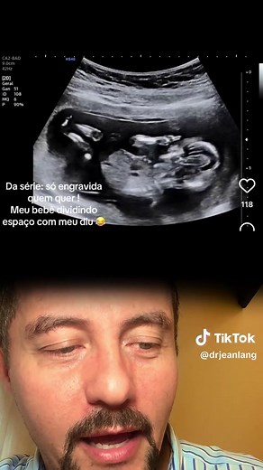 É possível engravidar com DIU ? Assista essa história onde realizei o acompanhamento através das ultrassonografias. ⚠️ Se você quiser que eu avalie seu exame de ultrassom, basta clicar no link da minha BIO: “pergunte ao Dr° Jean”. Ⓜ️ Dr. Jean Lang - médico radiologista ☎️ Contato [Whats]: (27) 99923-3536 🏢 Instituto LANG #ultrassom #ultrassonografia #ultrassomobstetrico #ultrassommorfologico #ultrassomdoppler