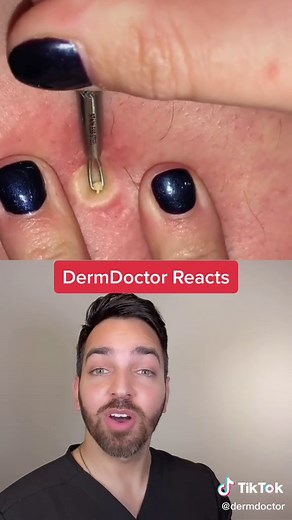 #duet with @samanthasalv #pimplepopping #skincare #dermatologist #sebaceouscyst #epidermoidcyst #cystpopping