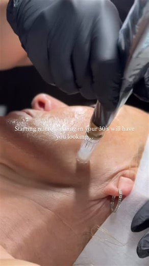✨ If you start microneedling in your 30s, you’re not just treating your skin now… you’re banking collagen for your future self. Collagen naturally declines every year after 25 so the earlier you support it, the better your skin ages long-term. That’s why clients who start earlier tend to experience: ✨ smoother texture ✨ firmer, bouncier skin ✨ better collagen retention ✨ softened fine lines ✨ refined pores When you pair microneedling Polynucleotides… you’re not just stimulating collagen you’re a