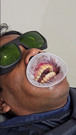 Veneers Before After 😍 | Smile Makeover in Just Few Days | Best Dentist in Indore