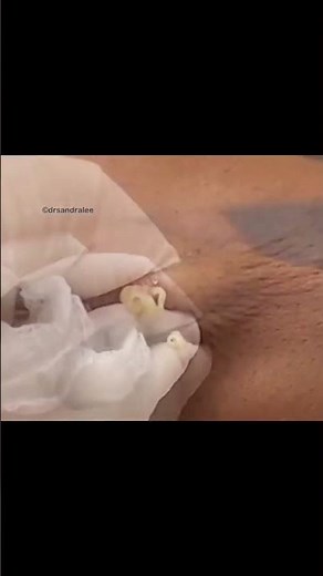 Got time for a steatocystoma video today? #drpimplepopper #popaholics #oddlysatisfying