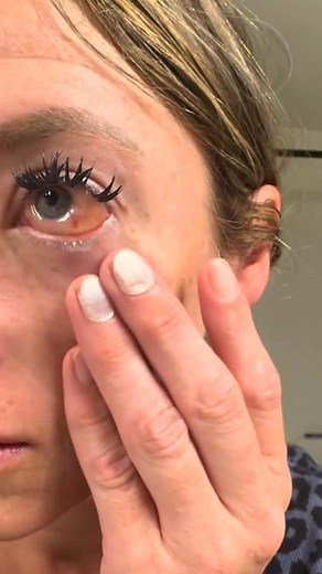 Optometrist & ophthalmologist 👀 | Chemosis means swelling (edema) of the conjunctiva, the thin, clear tissue covering the white part of the eye and inside the eyelids. It... | Instagram