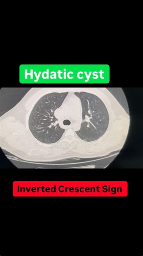 Radiology cases🧨 on Instagram: "📚The Inverted Crescent Sign on CT typically refers to a finding in pulmonary (lung) hydatid cysts, indicating a partially collapsed cyst where an air crescent forms at the posterior aspect of the lesion, separating the cyst wall (pericyst) from the internal membrane (endocyst) due to air dissection. It's a sign of impending rupture or a degenerating cyst, distinct from the regular crescent sign (anterior) or the water lily sign (floating membrane)."