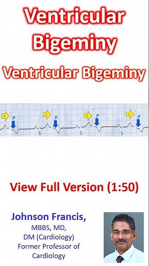 Ventricular Bigeminy